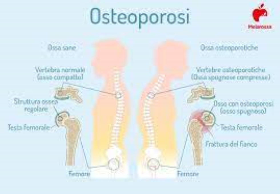 imm_2783_immagine-ossa-osteoporosi.jpg