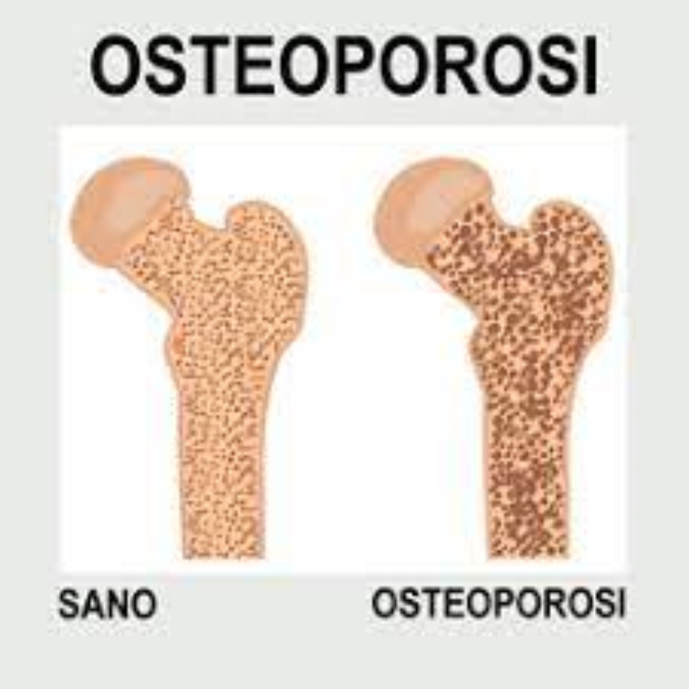 imm_9878_2-ossa-osteoporosi.jpg
